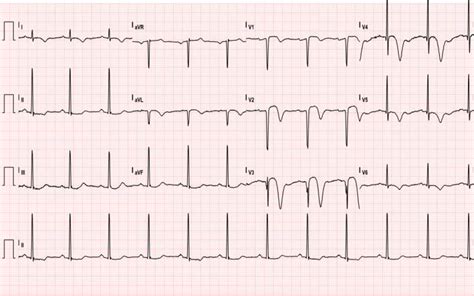 Wellens’ Sign (Wellens’ Syndrome) - JETem