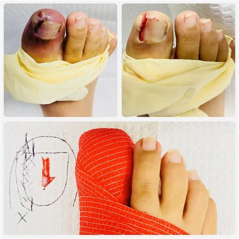 Ingrown Toenail Treatment: The Sunset Foot Clinic: Podiatry