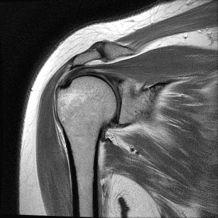 posterior labral tear shoulder mri