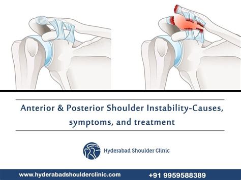 Anterior & Posterior Shoulder Instability - Causes, symptoms, and treatment