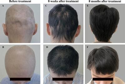 Scarring Alopecia