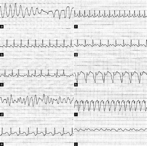 Fine Ventricular Fibrillation Vs Coarse Ventricular Fibrillation