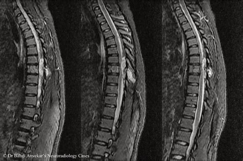 HEMANGIOMA SPINE MRI T1 T2 - Wroc?awski Informator Internetowy - Wroc ...