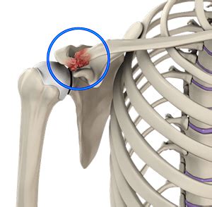 Acromioclavicular Joint Osteoarthritis Orlando, FL | AC Joint ...