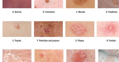 Medical Addicts: Terms used to describe skin lesions