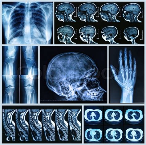 Radiography of Human Bones: x-ray and ... | Stock image | Colourbox