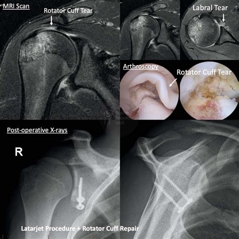 Labral Tears | Dr Pant - Sydney Shoulder Unit