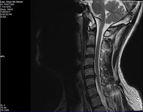 Cervical Herniated Disc (c5/c6) - Pain and Inflammation - Flux Health Forum