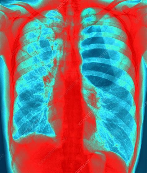 Pulmonary emphysema, X-ray - Stock Image - C021/2974 - Science Photo ...