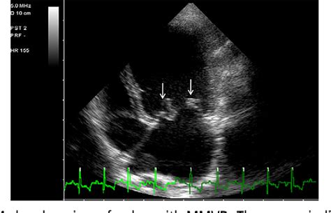 Myxomatous Mitral Valve Disease