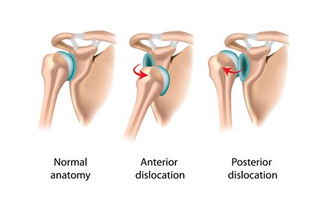 Shoulder Instability