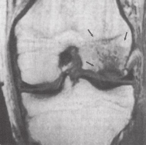 MRI scan showing a bone bruise on the lateral femoral condyle. Note the ...