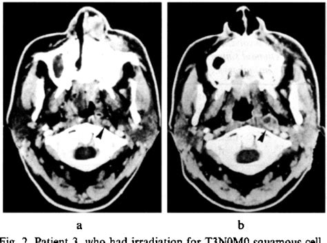 Figure 2 from CT of Retropharyngeal Lymph Node Metastasis from ...