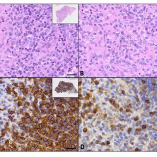 | Evaluation of left retropharyngeal lymph node biopsy via H&E staining ...