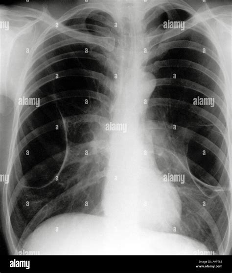 Chest x ray emphysema Stock Photo - Alamy