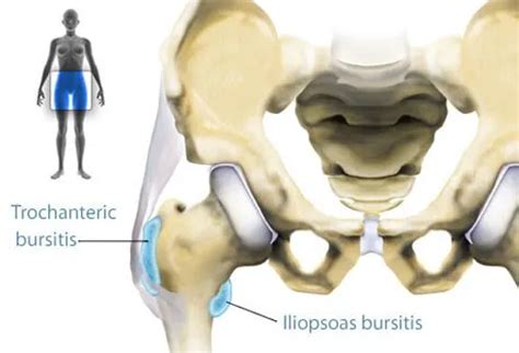 Bursitis Treatment, Causes, Symptoms, Prevention - Okkii.com