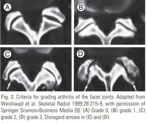 Facet Joint Arthropathy - Sports Medicine Review