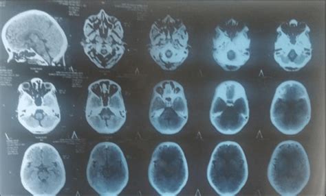 NCCT Brain depicting calcified granulomas are present in bilateral ...