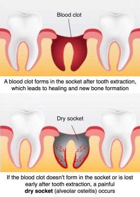 dry-socket - Pacific Oral Surgery