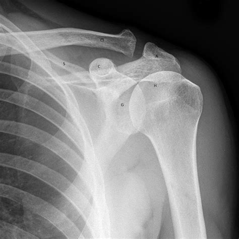 Approach to Traumatic Shoulder Pain – Core EM