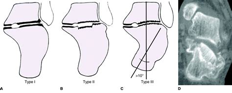 Calcaneus Fractures - Trauma - Orthobullets