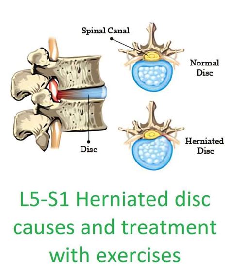 L5-S1 Herniated disc relief with 3 exercises to avoid surgery