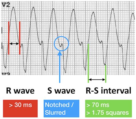 Vt Versus Svt • Litfl Medical Blog • Ecg Library Basics