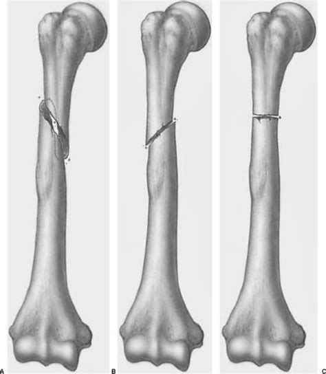 Humerus Fracture