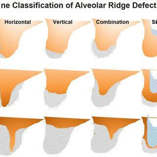 The Cologne Classification of Alveolar Ridge Defects (CCARD)² ...