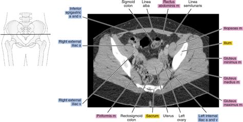 Ct Anatomy Pelvis Scan Muscle Pelvic Axial Iliacus Bone Labeled | The ...