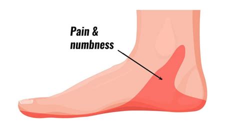 Inner ankle pain Archives - Sportsinjuryclinic.net