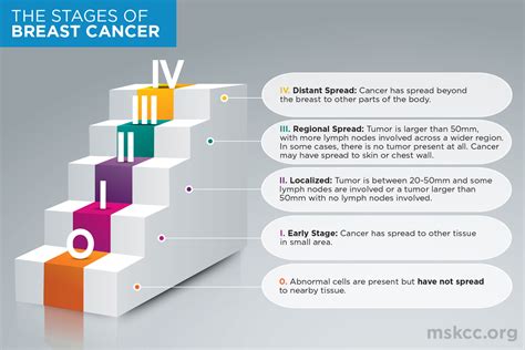 Breast Cancer Stages 0, 1, 2, 3 and 4 | Memorial Sloan Kettering Cancer ...