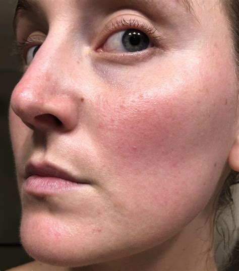 Day 1 on Triple Rosacea Cream : r/Rosacea