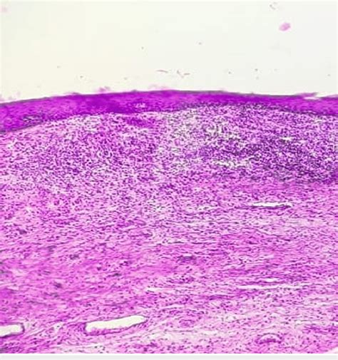 Embryo Implantation Cervix Stratified Squamous Epithelium Best | The ...