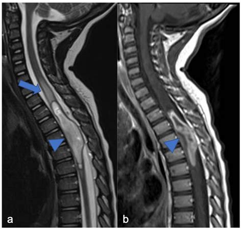 Mri Images Spine