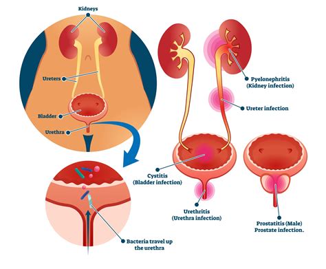 Should You Let UTI Go Away On Its Own? Here’s What To Consider