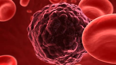 Leucemia o cáncer de la sangre: Causas, síntomas y tratamientos que ...