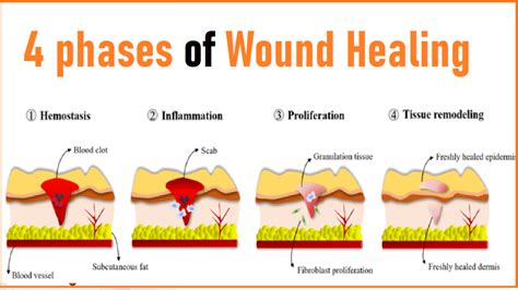 4 Stages Of Wound Healing Wound Healing Healing Color Change Images