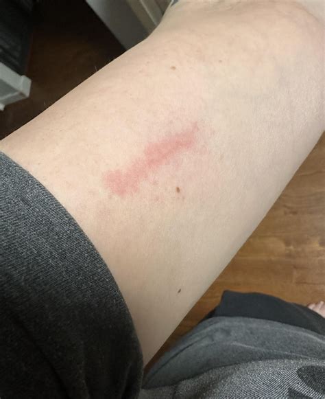 Can Anyone Please Help Me Identify This Rash On My Arm R