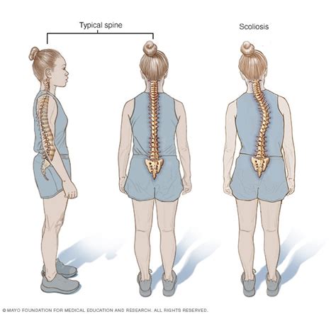 Scoliosis: Causes, Symptoms & Treatments | Global Treatment Services ...