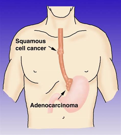 Esophagus Cancer & Treatment | Cancer Treatment USA