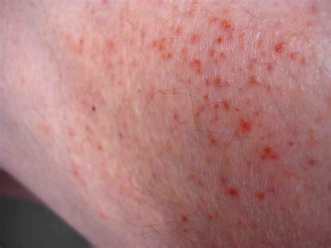 rash on whole body - pictures, photos