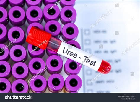 Urea Test Look Abnormalities Blood Blood Stock Photo 2232285679 ...