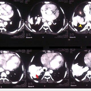 Contrast-enhanced computed tomography (CT) angiogram of the chest It ...