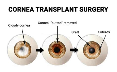 Cornea Transplant NYC - Vitreous Retina Macula Consultants of New York