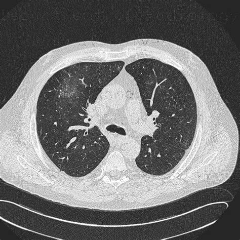 Radiology case: Hypersensitivity angiitis, intraalveolar hemorrhage, HRCT