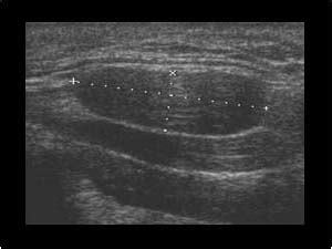 Ultrasound Benign Lymph Nodes Neck