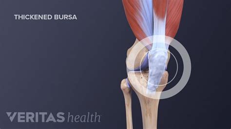 Knee (Prepatellar) Bursitis