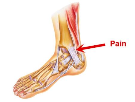 Inner Ankle Pain While Running - Capital Physiotherapy