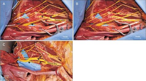 A multiply split femoral nerve and psoas quartus muscle. — Seattle ...